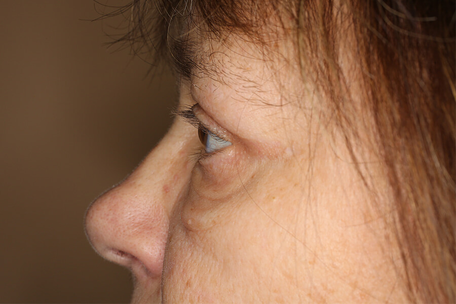 Oberlidplastik postoperativ 2
