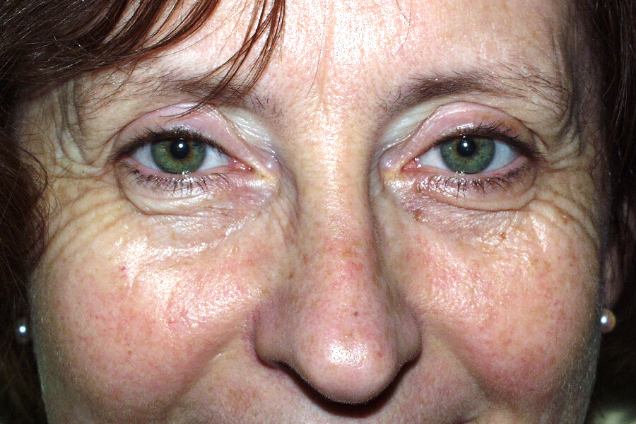 Krähenfüße mit Botox behandeln