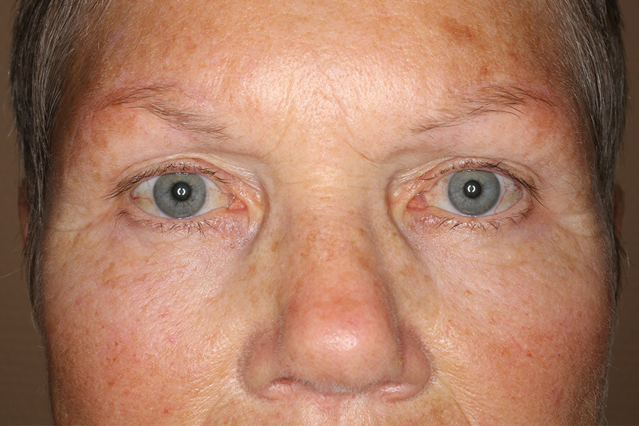 Augenbrauenlift nach der OP nach McCord