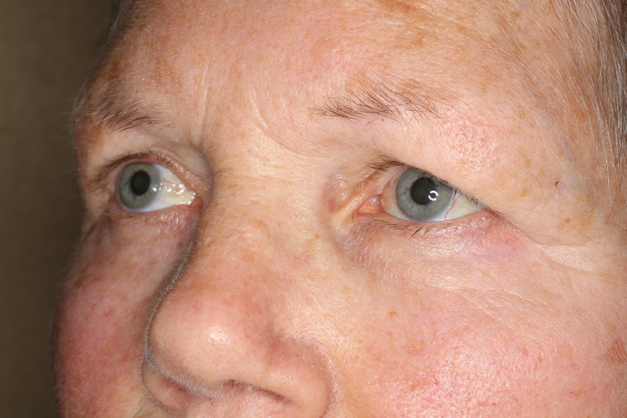 Augenbrauenlift vor der OP halbseitlich