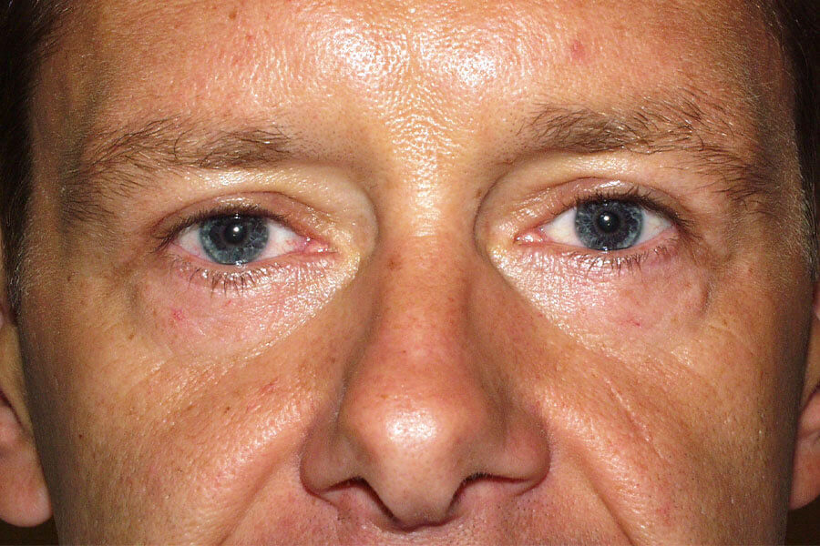 Operationsergebnis 3 Monate postoperativ