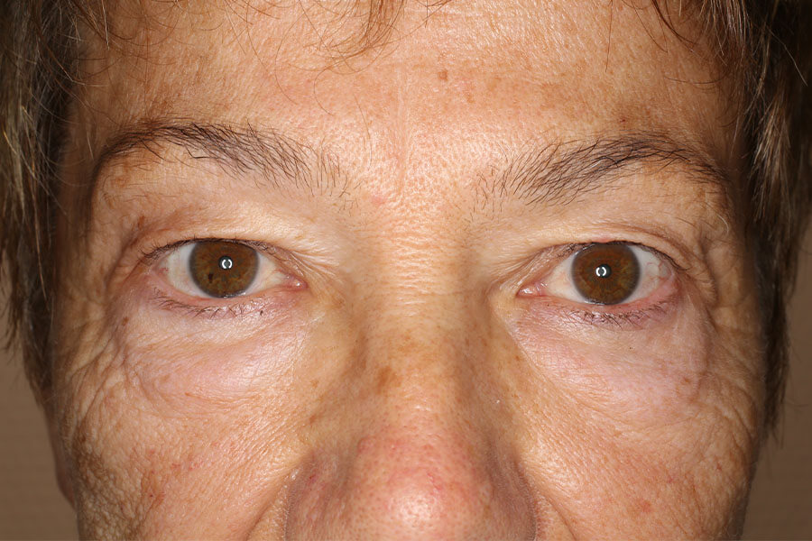 Innere Kanthopexie vor der OP, nach Botox