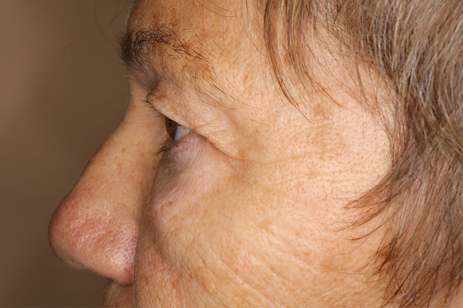 Vor der OP, nach Botox-Therapie