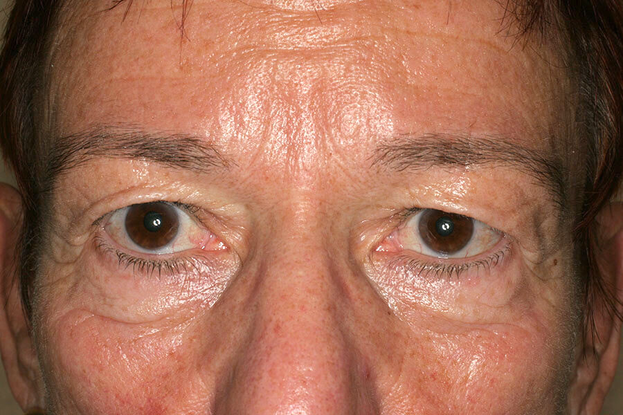 Präoperative Botox-Therapie