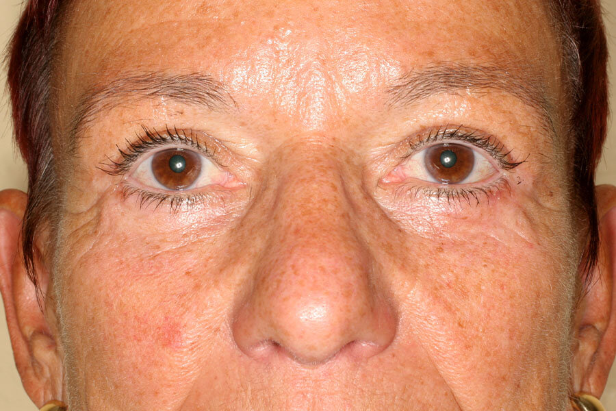 3,5 Monate postoperativ