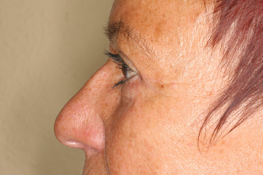 3,5 Monate postoperativ